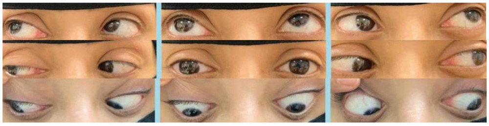 Nine-gaze image showing left hypertropia which increases on left gaze. There is limitation of elevation of the right eye on attempted adduction.