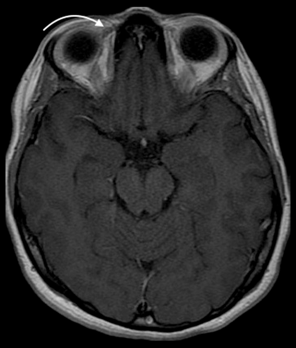 MRI T1 showing thickening and irregularity involving the right superior oblique tendon-trochlea complex (arrow).