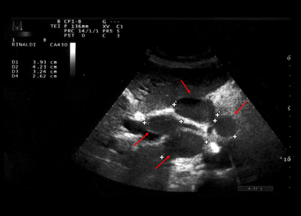 Nodal peri-pancreatic aggregate, adjacent to the left-lobe liver, indicated by the arrows.