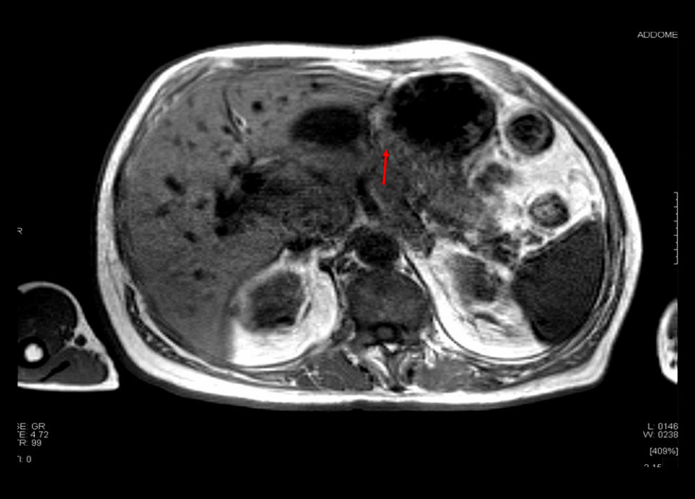 MRI: retroperitoneal, polycyclic, and inhomogeneous mass, defined as “likely attributable to lymphoma”. The arrow indicates the main lymph node aggregates.