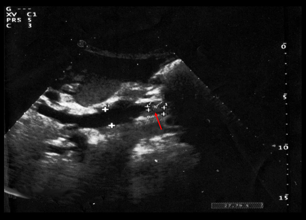 The concentric wall thickening, with a visibility of the residual lumen of the common bile duct indicated by the arrow.