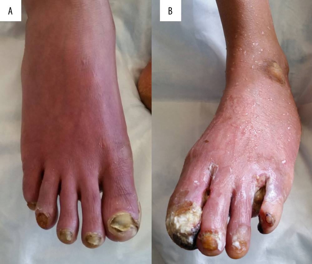 The feet of the patient on admission: (A) The right foot showing signs of chronic candidiasis of the nails, including discoloration, dystrophy, and brittle nails. (B) The left foot showing signs of acute infection, chronic candidiasis, dystrophy of nails, and signs of critical ischemia, including the amputated 4th toe and gangrene of the tip of the 1st toe.