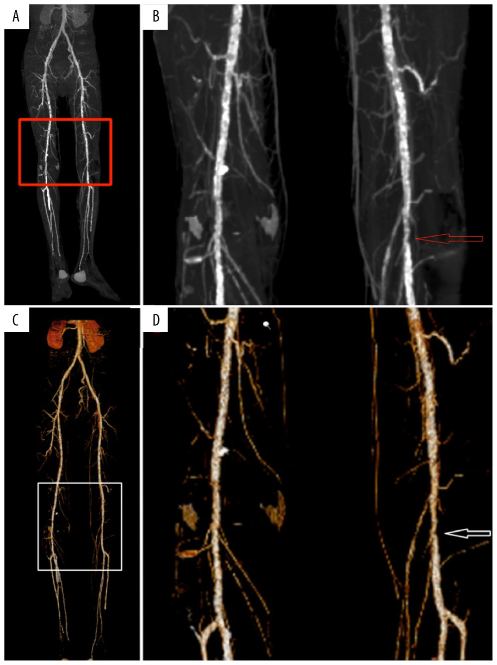 CT angiography of the abdominal aorta and lower limbs on admission showing the heavy calcifications of the arteries, which appear as hyperdense white areas. (A) CT angiography MIP (maximum intensity projection). (B) Magnification and focus on the popliteal area of the MIP image. (C) CT angiography VIP (volume intensity projection). (D) Magnification and focus on the popliteal area of the VIP image. The arrows in (B, D) point to the site of severe stenosis in the popliteal artery.