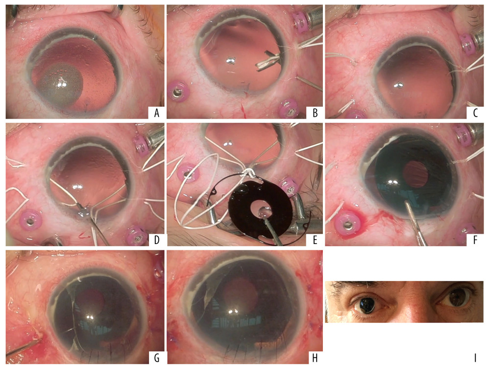 Procedure steps and final result. (A) Beginning of the procedure, with the eye showing aphakia, subtotal aniridia, and silicone oil droplets. (B) Suture insertion from one temporal sclerotomy and externalization from the adjacent one, using the handshake technique. (C) The same step from the nasal side. (D) Externalization of 2 suture loops from a small limbal incision at 12 o’clock. (E) Ab externo preparation of the lens, with a cow hitch knot centered at the haptic holes. (F) Lens insertion from the enlarged limbal incision. (G) Rotation and pushing of the knot inside the eye. (H) End of the procedure. (I) Final result 6 months after the operation.