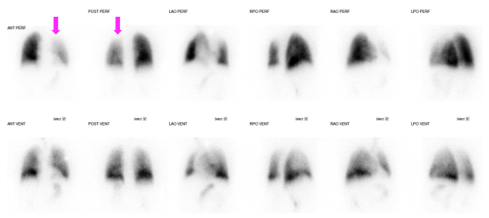 Ventilation/perfusion scan prior to pulmonary vein stenting. Pink arrows indicate the left lung with decreased perfusion compared to the right.