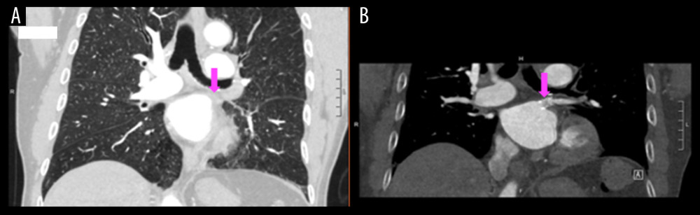 A (pink arrow) shows the left superior pulmonary vein that is completely occluded. B (pink arrow) shows a patent left superior pulmonary vein after stenting.