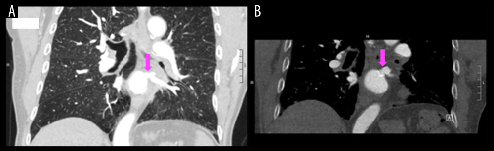 A (pink arrow) shows the left inferior pulmonary vein with ostial stenosis. B (pink arrow) shows a patent left inferior pulmonary vein after stenting.