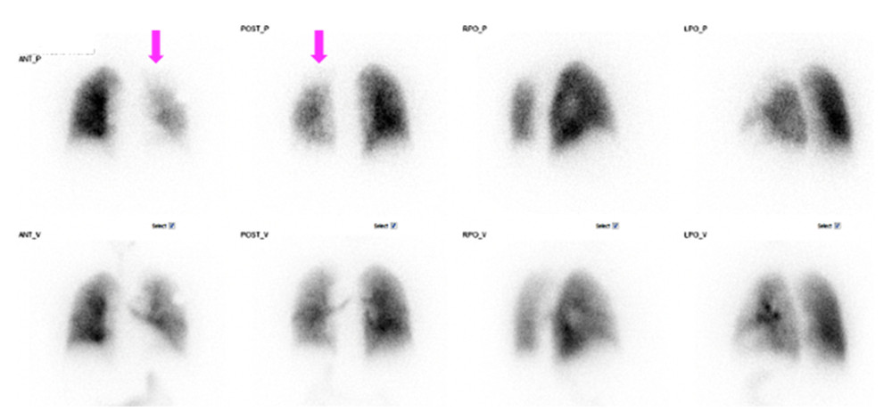 Ventilation/perfusion scan after pulmonary vein stenting. Pink arrows indicate the left lung with slightly increased perfusion compared with Figure 1.