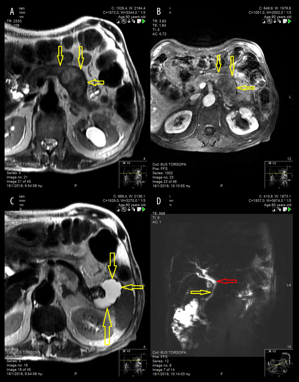 Diffuse cystic dilation at the pancreatic body and tail with severe parenchymal heterogeneity shown in (A) T2W2 abdominal MRI (arrows), and (B) vibe post contrast abdominal MRI (arrows). (C) T2-weighed abdominal MRI: cystic lesion with compact elements and high signal intensity in contact with the tail of the pancreas and the hilum of the spleen (arrows). (D) MRCP: mild dilation of the common hepatic duct (red arrow) with smooth stenosis of the common bile duct (yellow arrow). Absence of visualization of the major or accessory pancreatic duct. MRI – magnetic resonance imagining; MRCP – magnetic resonance cholangiopancreatography.