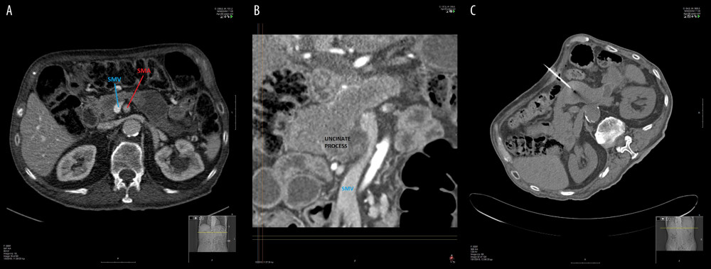 Abdominal computed tomography angiography, portal phase as shown in (A) multifocal hypodense pancreatic neoplasm. (B) Hypodense cystic lesion at the head and uncinate process of the pancreas with distortion of the superior mesenteric vein. (C) Computed tomography-guided biopsy of the cystic lesion at the body and tail of the pancreas. SMV – superior mesenteric vein; SMA – superior mesenteric artery.