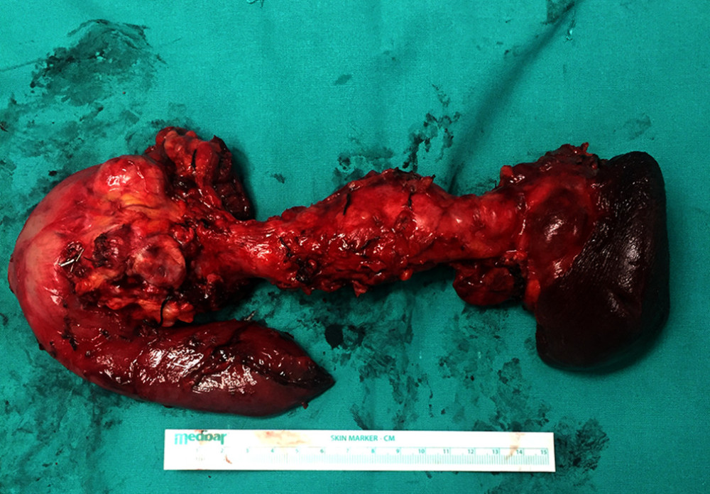 Gross specimen photo of total pancreatectomy with splenectomy.