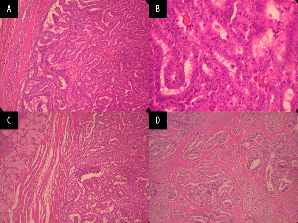 Histopathological images of ITPN as shown in (A) The duct is completely filled by the tubule and few papillae forming neoplasm (H&E 100×). (B) Dense packed tubules and papillae with moderate to severe nuclear atypia. Note the absence of mucin (H&E 200×). (C) ITPN below the duodenum wall (H&E 100×). (D) Focus of invasive ductal carcinoma (H&E 200×). ITPN – intraductal tubulopapillary neoplasm; H&E – hematoxylin and eosin.