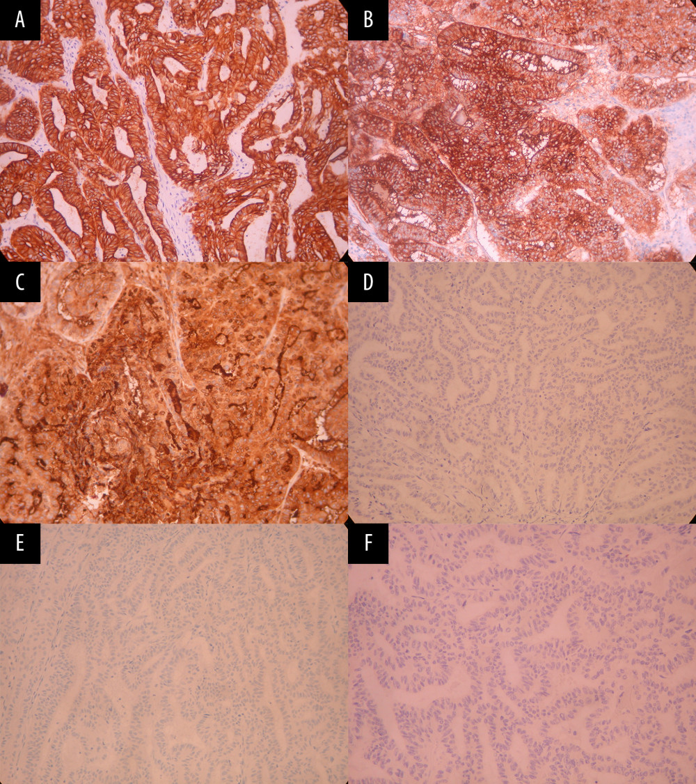 Immunohistochemical images of ITPN. (A) The tumor cells are positive for cytokeratin 7 (immunostain 200×). (B) The tumor cells are positive for CA 19-9 (immunostain 200×). (C) The tumor cells are positive for MUC1 (immunostain 200×). (D) The tumor cells are negative for cytokeratin 20 (immunostain 200×). (E) The tumor cells are negative for MUC2 (immunostain 200×). (F) The tumor cells are negative for CDX2 (immunostain 200×). ITPN – intraductal tubulopapillary neoplasm.