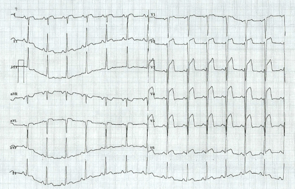 EKG on admission. There is a notable ST segment elevation in leads V2 to V6 and discrete elevation in DI and aVL derivations, confirming an extensive anterior wall AMI with ST elevation. AMI – acute myocardial infarction.