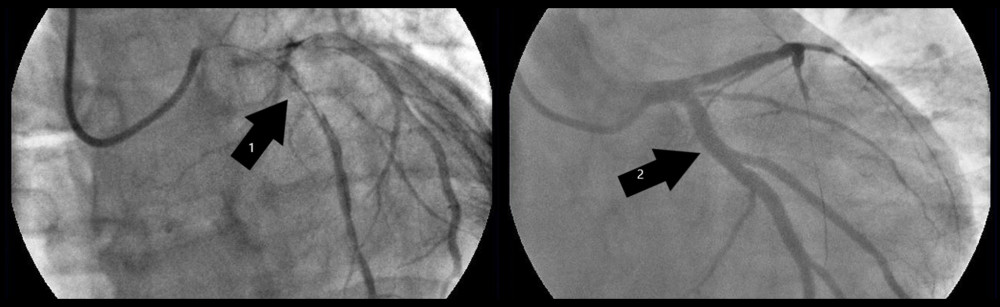 Emergency angioplasty of left coronary anterior descending branch. Arrow 1: Occluded artery, passed by guidewire. Arrow 2: After insertion of drug-eluting stent.