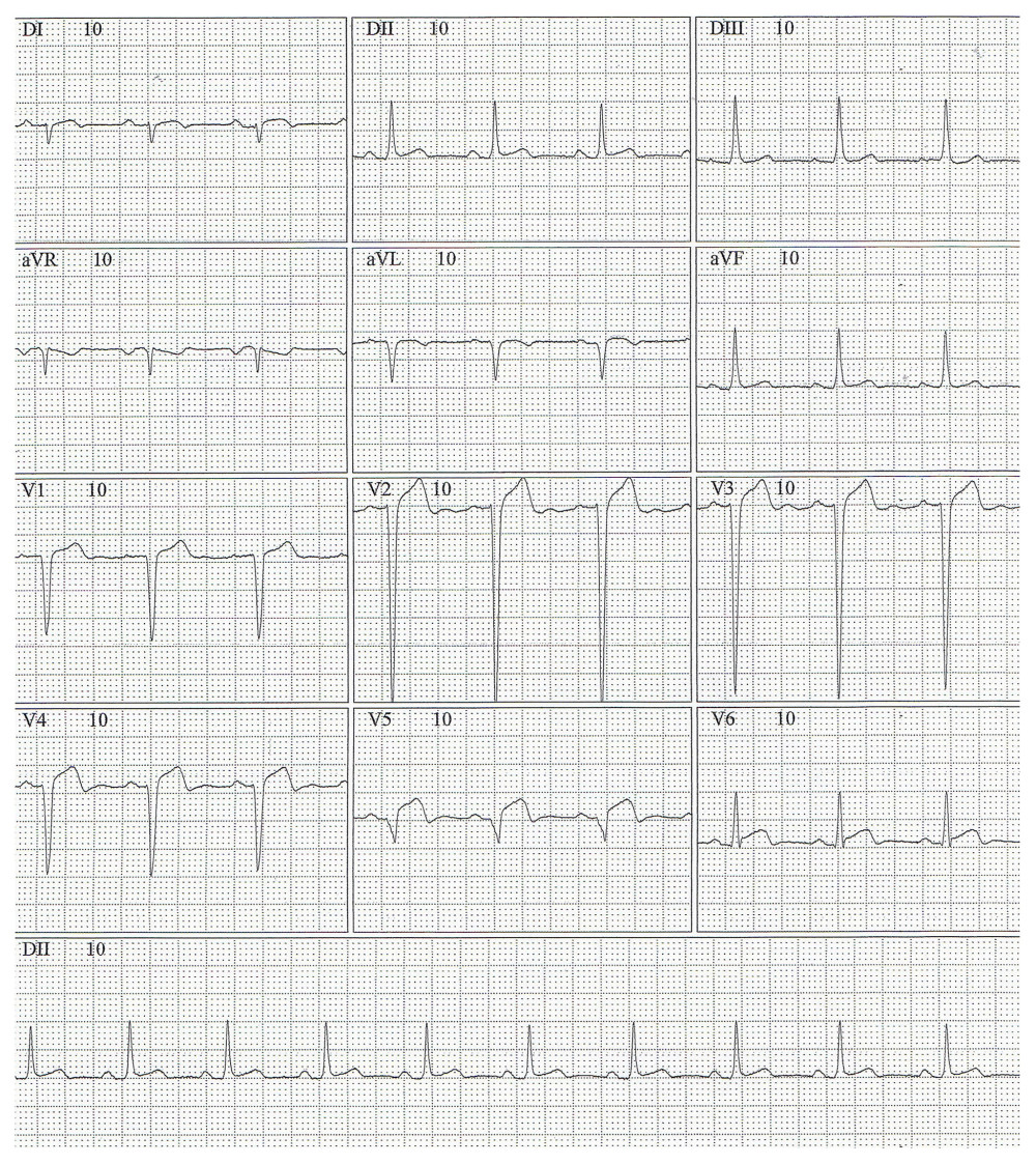 EKG 4 weeks after AMI, showing persistence of ST segment elevation in V2 to V6 derivations and pathological Q waves in leads V2 to V5 and DI and aVL derivations. These findings indicate large extension and left ventricle compromise.