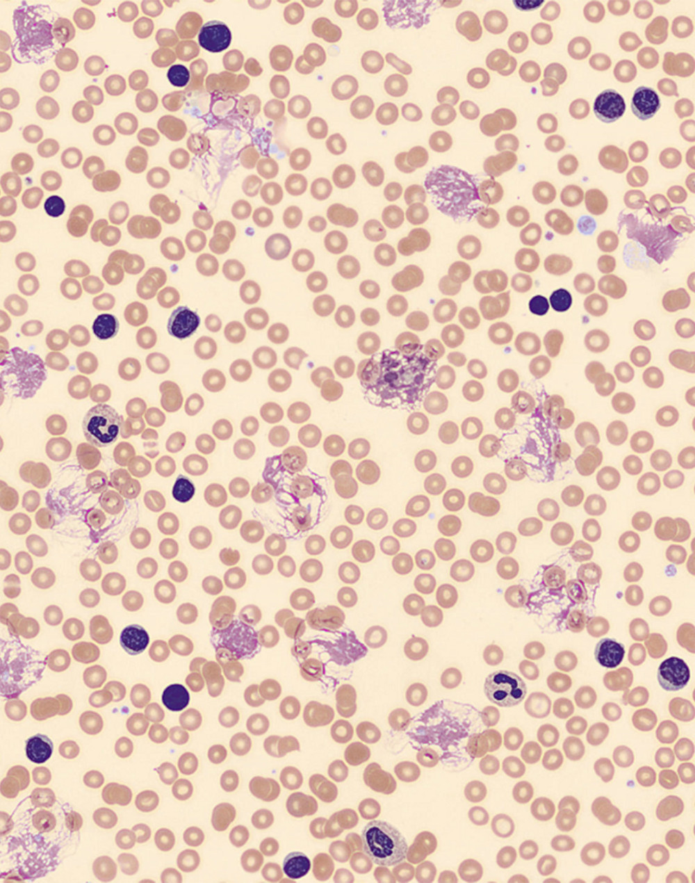 Hematoxylin & eosin-stained peripheral blood film showing many small and large lymphocytes, prolymphocytes, and smudge (CLL) cells.