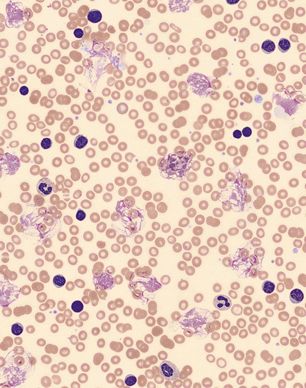 Hematoxylin & eosin-stained peripheral blood film showing many small and large lymphocytes, prolymphocytes, and smudge (CLL) cells.