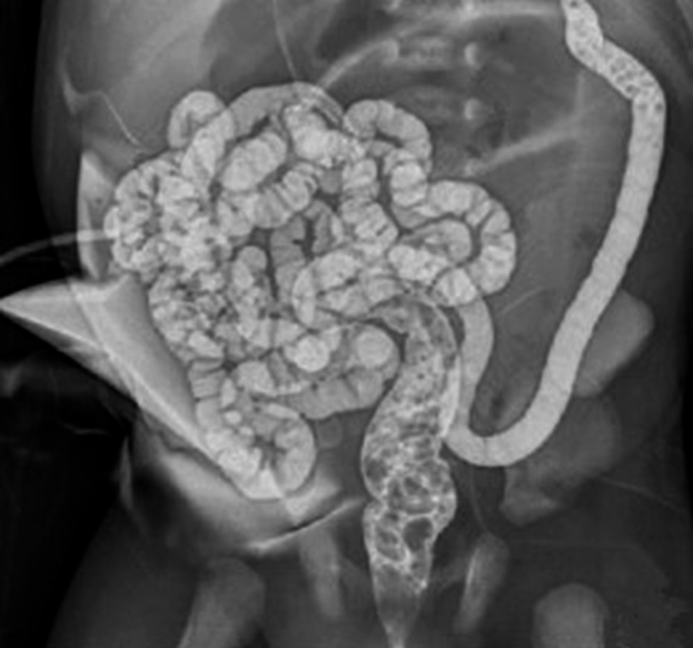 Distal fistula imaging (Before succus entericus reinfusion, distal fistula imaging was used to observe patency).