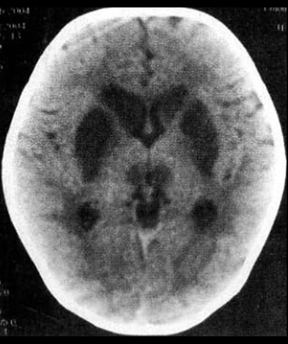 Bilateral basal ganglia striatum, caudate nucleus head, and medial dorsal nucleus were symmetrical, and the density was decreased.