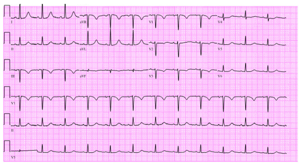 Electrocardiogram at time of admission showing normal sinus rhythm with left ventricular hypertrophy and prolonged QTc interval of 486 milliseconds.