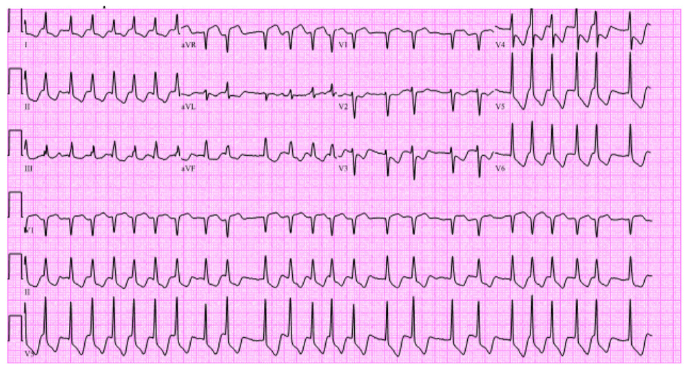 Electrocardiogram after return of spontaneous circulation from pulseless electrical activity/ventricular tachycardia arrest showing atrial fibrillation with rapid ventricular response.
