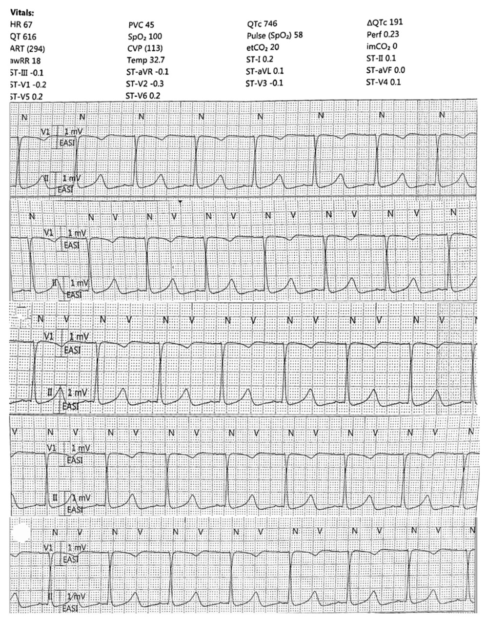 Telemetry strip showing QTc prolongation of 746 milliseconds, noted at 32.9°C, resulting in termination after 8 hours of therapeutic targeted temperature management.