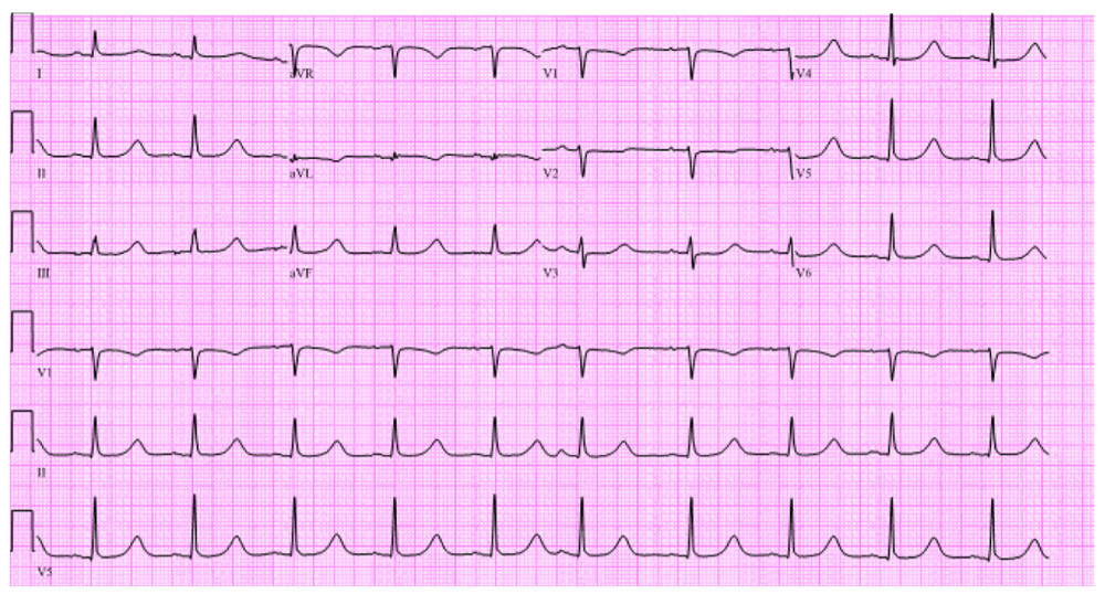 Electrocardiogram done 30 minutes after targeted temperature management termination showing QTc prolongation of 612 milliseconds.