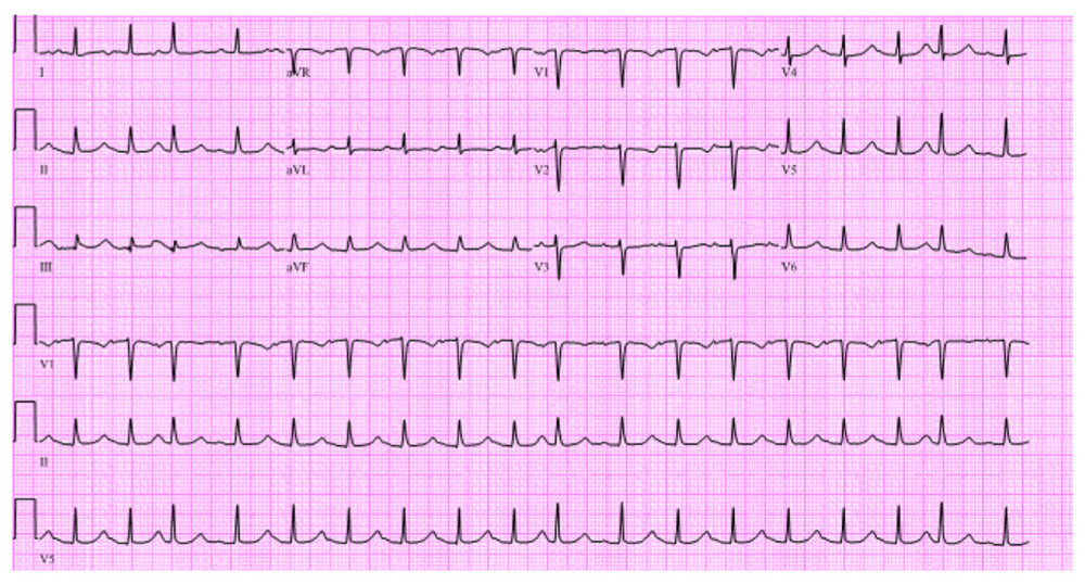 Electrocardiogram done after 16 hours of targeted temperature management cessation and at 36.3°C showing improved QTc prolongation to 503 milliseconds.