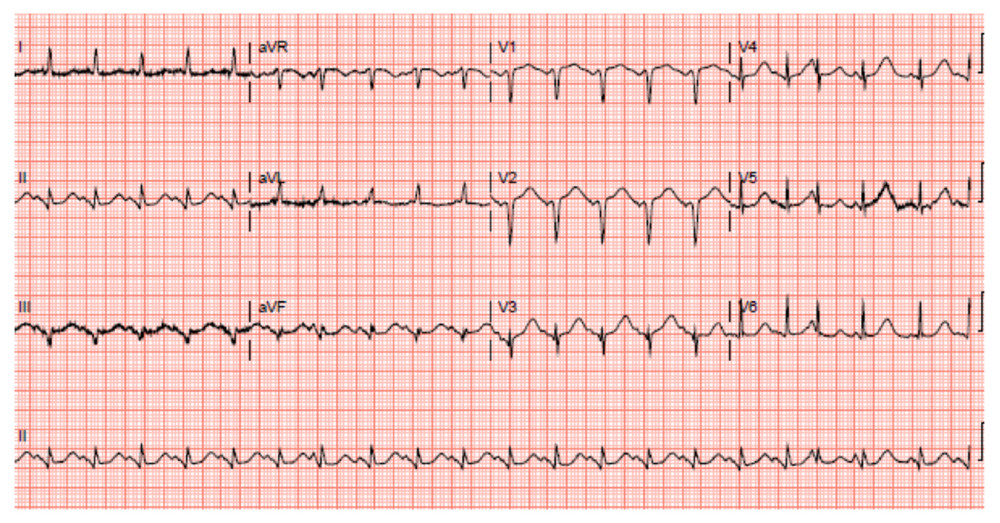 ECG on day 1: Sinus rhythm with marked QT prolongation and left bundle branch block.