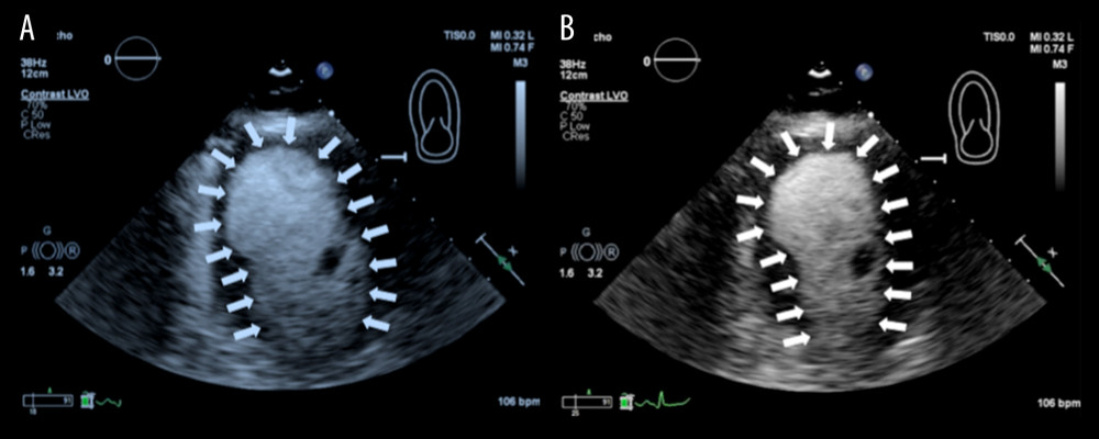 2D echocardiogram with Definity® ultrasound contrast. Two-chamber view showing left ventricular apical ballooning and normal base contractility. (A) Systole, (B) diastole.