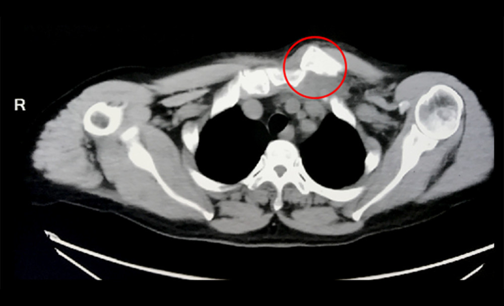 Axial computed tomography image at the initial injury demonstrated the left sternoclavicular dislocation (red circle).