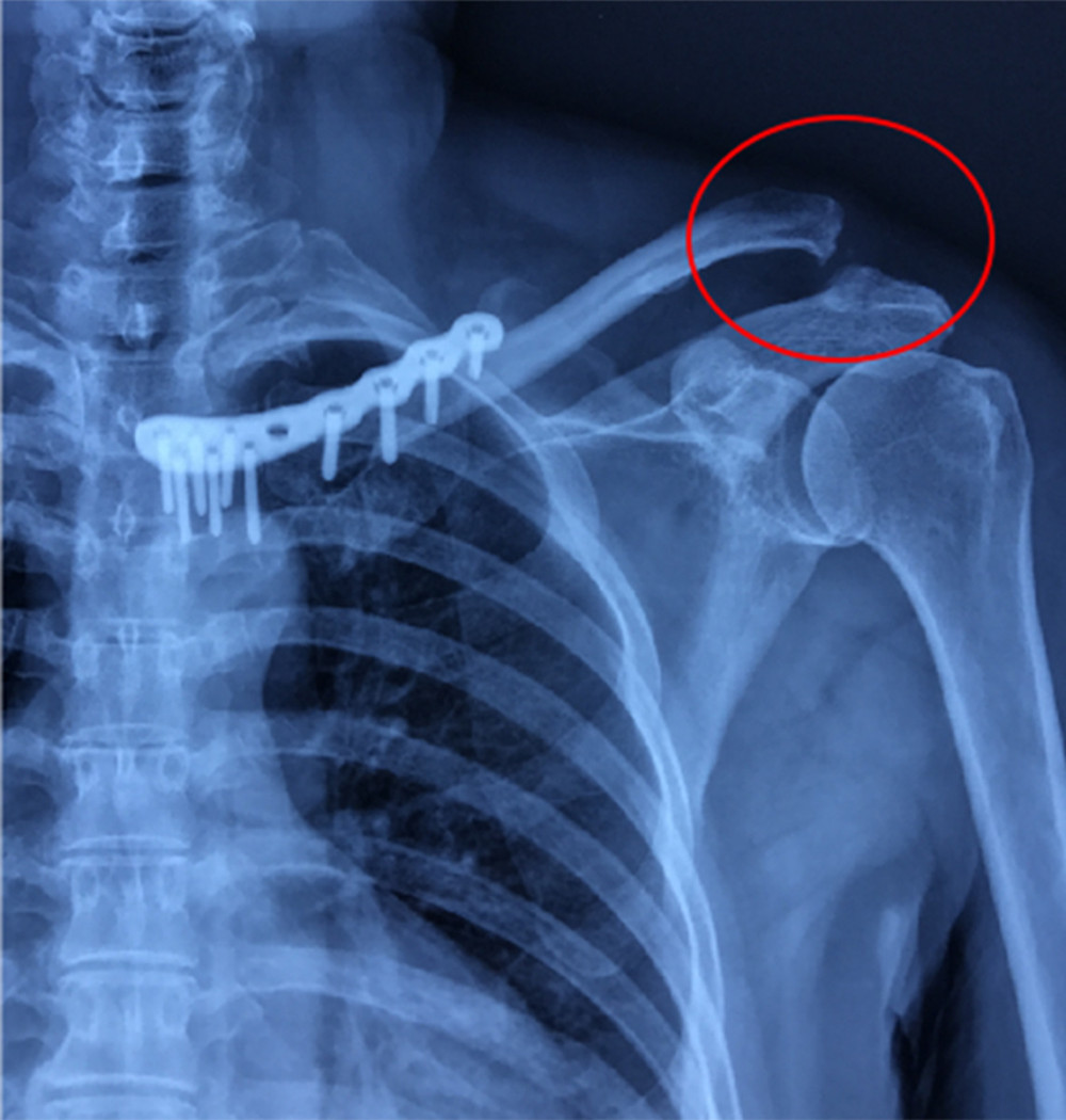 Radiography image 1 month after the left sternoclavicular reconstruction revealed the left acromioclavicular dislocation (type V injury – Rockwood classification) (red circle).