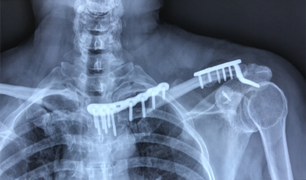 Postoperative radiography image indicated that the sternoclavicular joint and the acromioclavicular joint were reduced.
