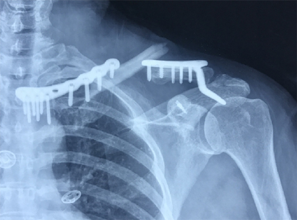 Plain radiography images at the second injury revealed the left clavicle shaft fracture.