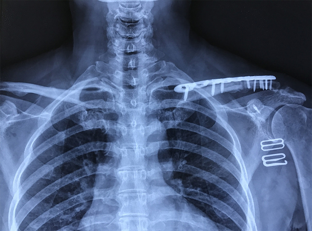 Postoperative radiography image of osteosynthesis for clavicle shaft fracture. We removed the plates from the ends of the clavicle and replaced them with a long clavicular plate for the clavicle shaft fracture.