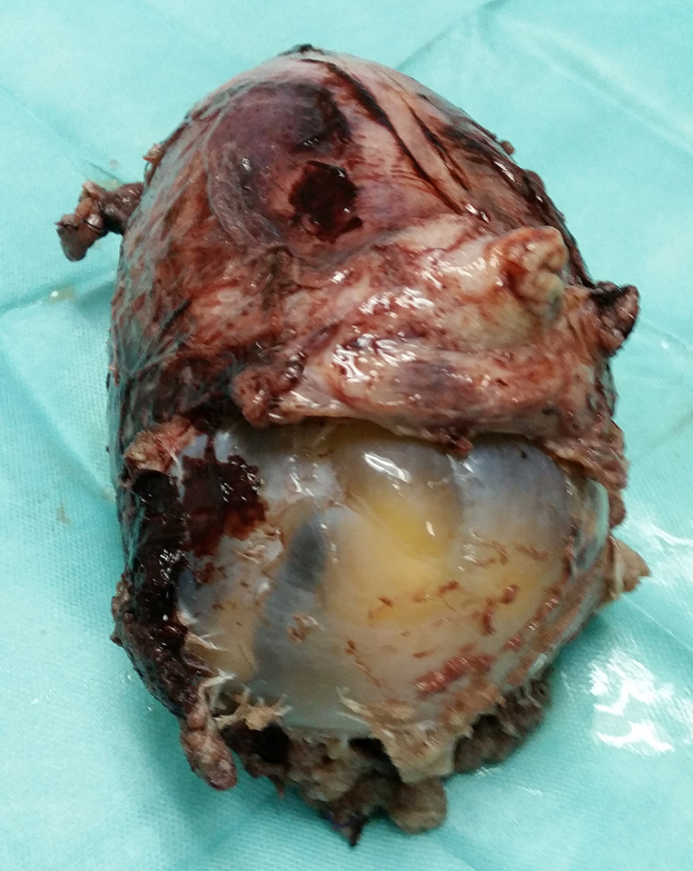 Post subtotal hysterectomy specimen showing uterine rupture with intact amniotic sac and fetus in situ.