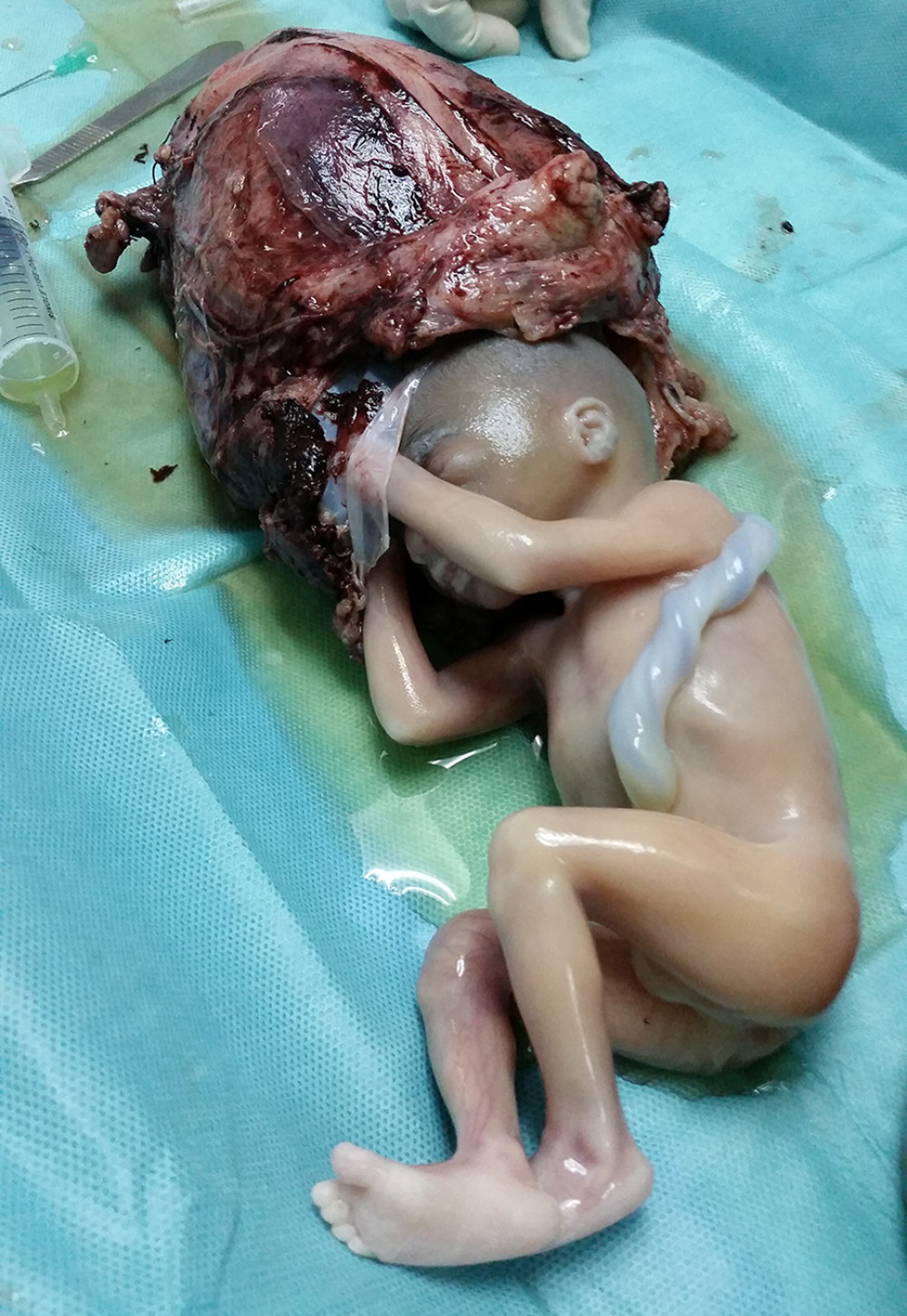 Stillbirth protruding out after iatrogenic rupture of the amniotic sac.