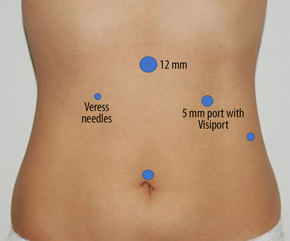 Veress needle at Palmer’s point, first 5 mm port with Visiport at the left midclavicular line, 11 mm supraumbilical port, a 12 mm epigastric port, and 5mm port at left anterior axillary line.
