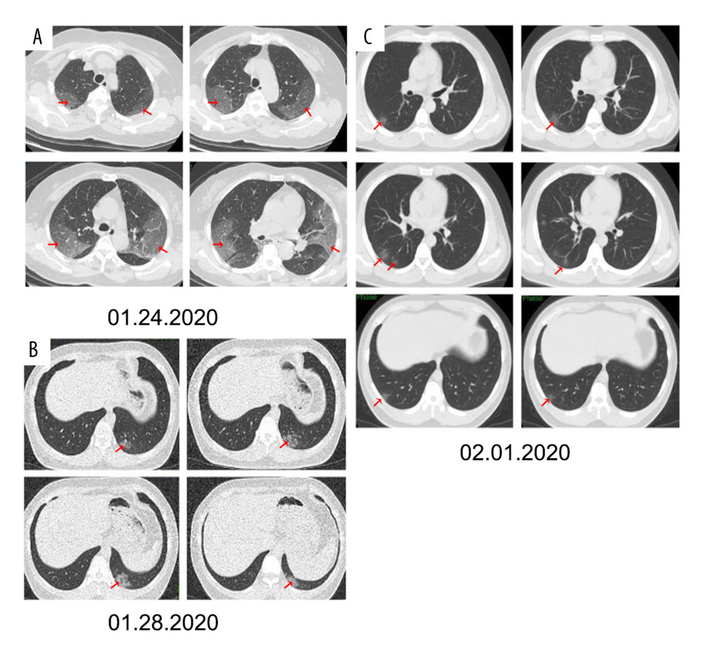 Chest CT on Day 5 for 3 patients, (A) Patient A, multiple, large, peripheral ground-glass opacities in both lungs (arrows). (B) Patient B, small peripheral ground-glass opacities in the left lower lobe (arrows). (C) Patient C, multiple small, peripheral ground-glass opacities in right lungs (arrows).