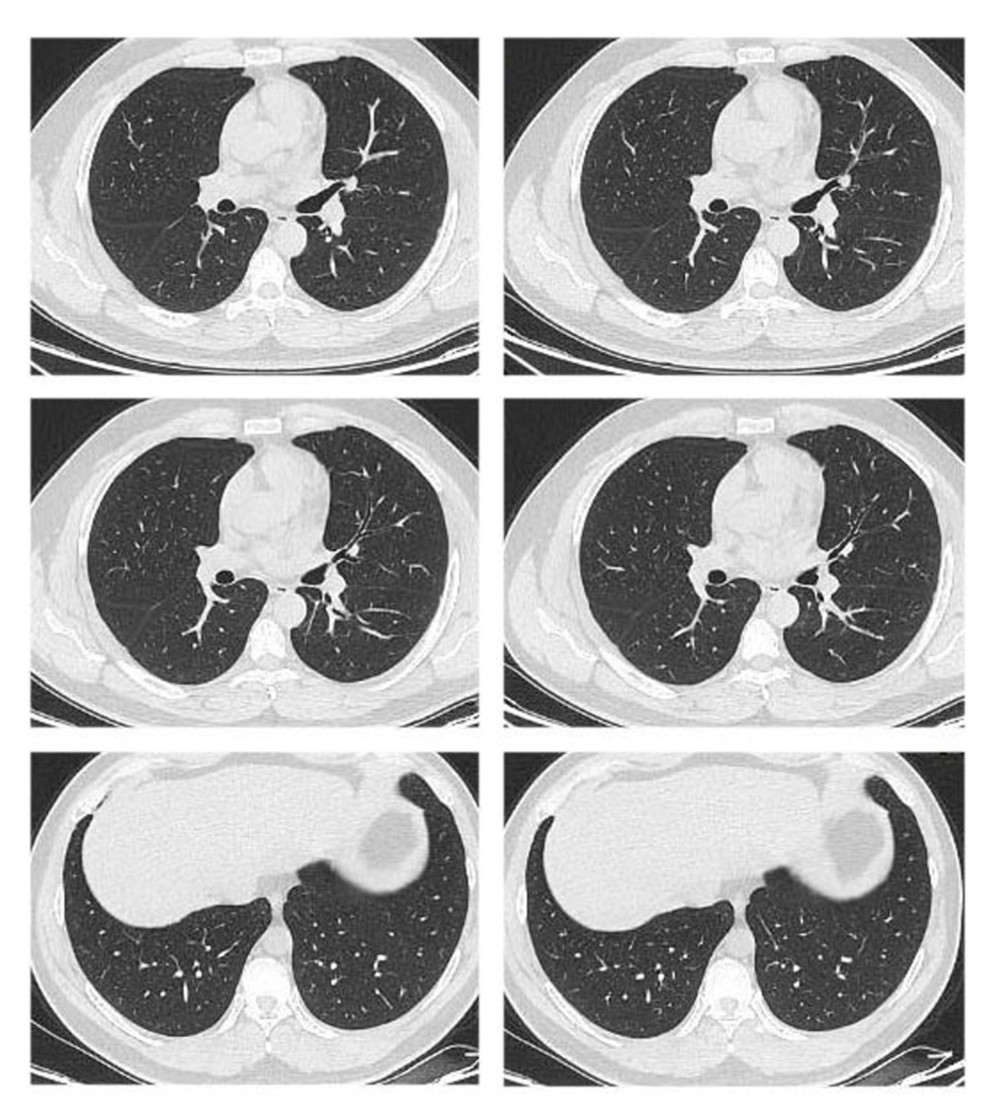 Day 1 for patient C, shows a normal chest CT scan.