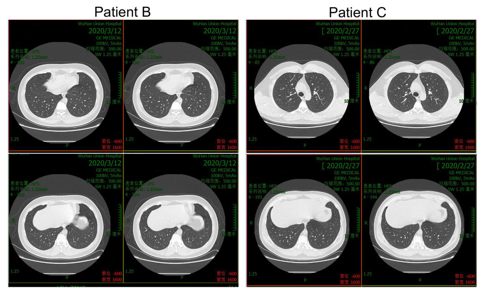 Follow-up CT scan of patients B and C.