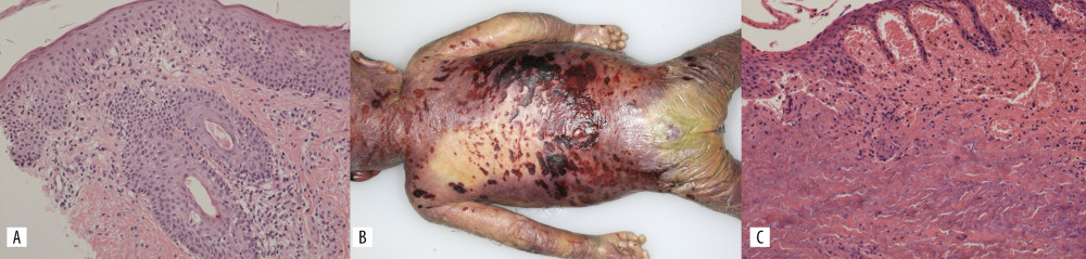 Pathological features of the skin. (A) DOL33, a skin biopsy, demonstrated vacuolar interface dermatitis with superficial perivascular infiltration (hematoxylin and eosin staining (H&E), ×75). (B) Grossly, an autopsy revealed that severe erythroderma with cutaneous erosions and hemorrhages was widely distributed. (C) Microscopically, the epidermis showed an erosive and necrotic change with bacterial infection, and the dermis exhibited severe inflammatory cell infiltration in the autopsy (H&E, ×75).