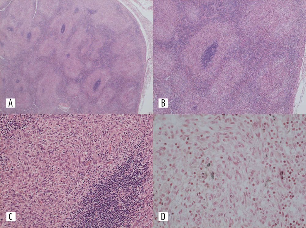 Microscopical features of the lymph node. (A, B) Atrophic germinal centers without mantle zone were sparsely distributed (H&E, ×15, ×30, respectively). (C) The germinal centers were surrounded by many spindle-shaped cells (H&E, ×150). (D) Fontana-Masson staining revealed many melanin particles in the macrophages (Fontana-Masson staining, ×300).