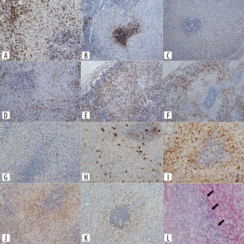 Immunohistochemistry for CD3 (A), CD20 (B), CD4 (C), CD8 (D), CD68 (E), CD163 (F), CD1a (G), Langerin (H), S100p (I), CD123 (J), and CD56 (K) in the lymph nodes. Double immunostaining revealed CD123 (red) and CD56 (blue) co-expression in the PDCs (L, arrows).