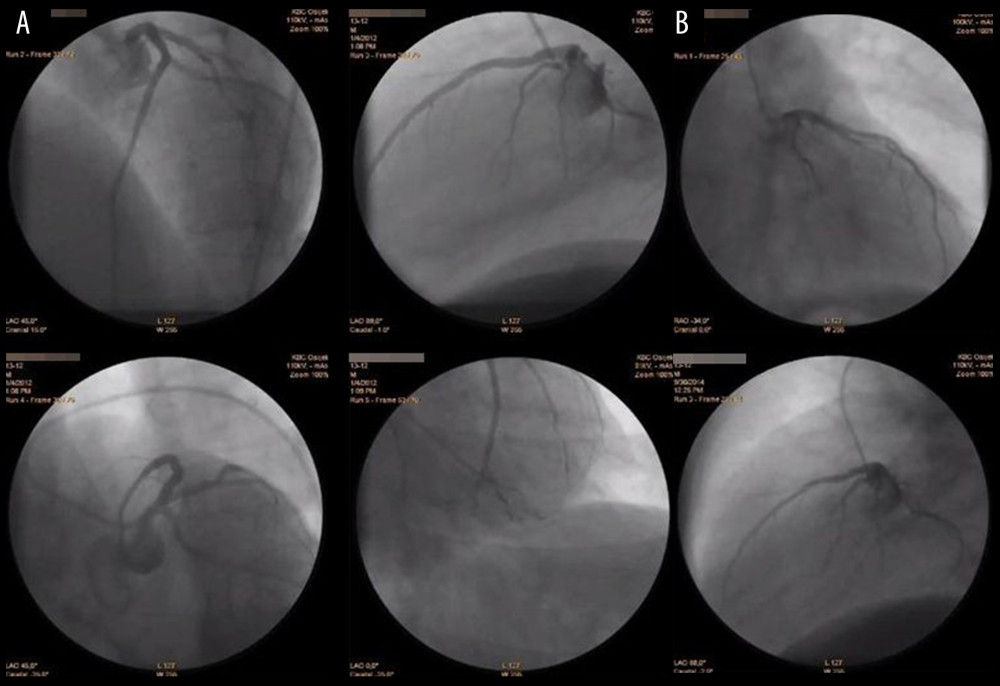 Coronary angiography performed during hospitalizations because of acute coronary syndrome – both times slow rinse of contrast, without atherosclerotic plaques: (A) Hospitalization in 2011. (B) Hospitalization in 2014.