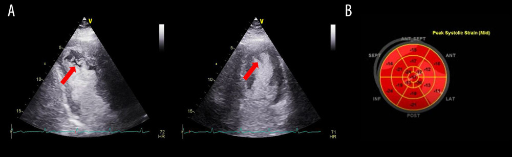 Two-dimensional transthoracic echocardiography (2D TTE) performed in 2019: (A) Contrast 2D TTE showing slow rinse of contrast in apical and distal anterolateral segment of left ventricular cavity; (B) strain 2D TTE showing reduced longitudinal strain in left ventricular apical and medial/distal anterolateral segment.