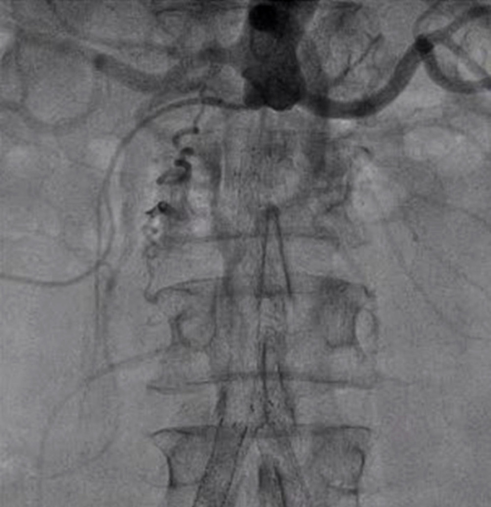 Conventional angiography revealed total occlusion of infra-renal aorta to both iliac arteries with a nonfunctioning aortoiliac stent.