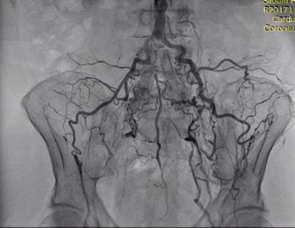 Distal blood flow origin from lumbar and sacral aorta branches.