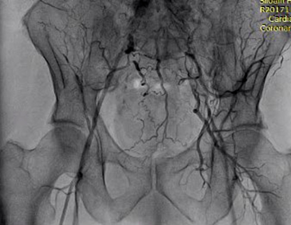 Good runoff blood flow to right and left common femoral arteries.